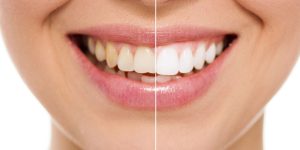 Whitening Solutions